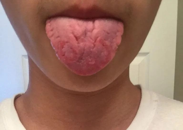 When Your Tongue Shows This Signal: Don't Delay!