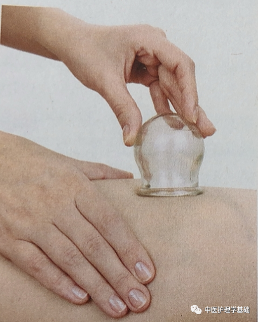 Ancient Health Preservation and Disease Prevention Secrets Passed Down by Our Ancestors: Cupping Therapy
