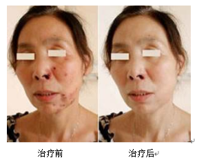 Fire Needle Therapy for Skin Diseases: Visible Safety and Efficacy