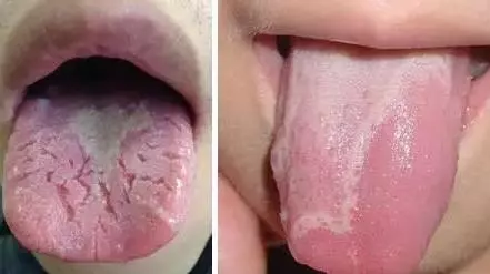 What Does Traditional Chinese Medicine Observe in the Tongue? Nine Body Types and Valuable Tongue Diagnosis Charts!