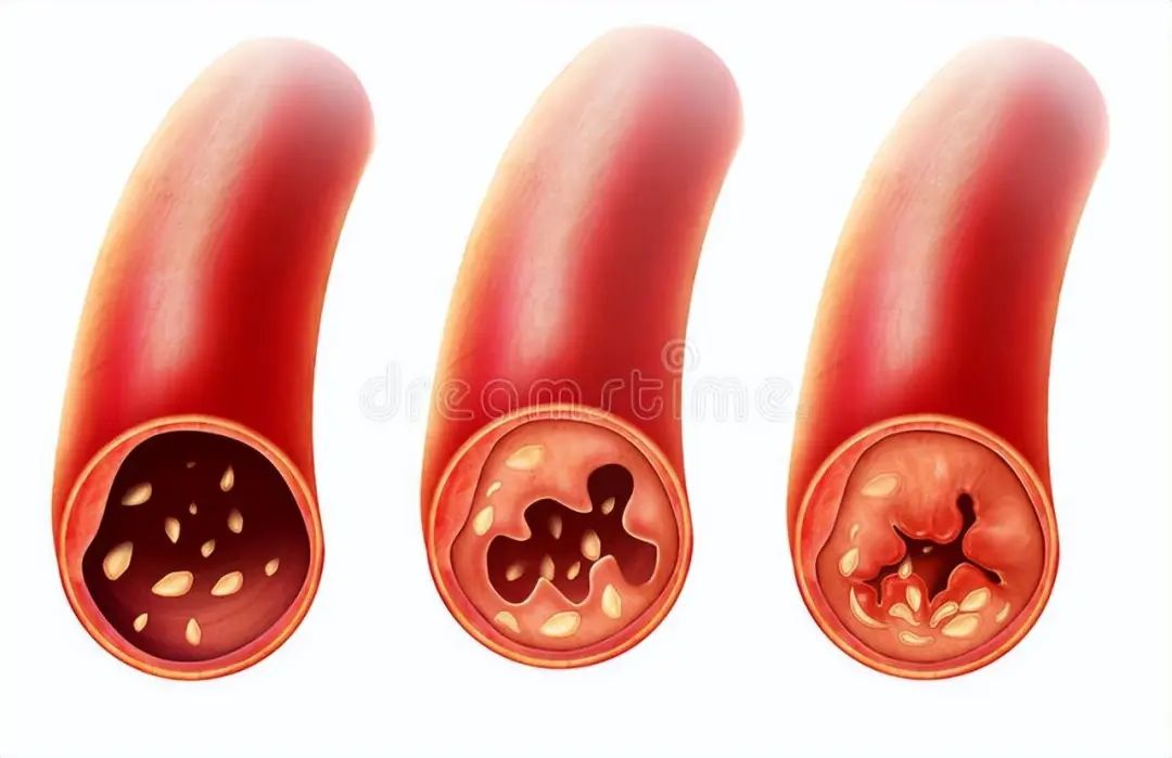 5 Herbs for Activating Blood Circulation, Resolving Stasis, Alleviating Pain, and Improving Chest Tightness, Precordial Pain, Dizziness, and Headaches