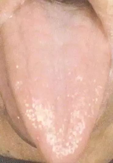 The Most Comprehensive Guide to Tongue Diagnosis! Master It and Become a Tongue Diagnosis Expert