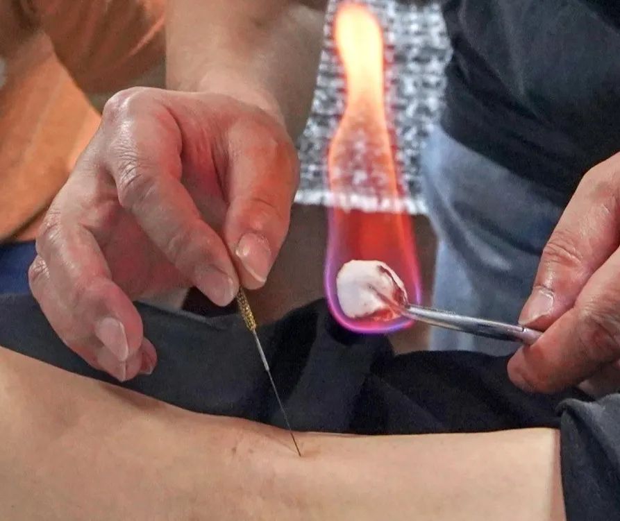 The Marvel of Fire Needle Therapy in Traditional Chinese Medicine