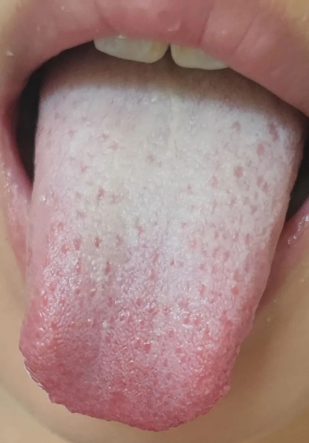 Tongue Diagnosis in Taiyang Disease According to the Treatise on Cold Damage