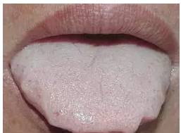 Symptoms and Dietary Remedies for Blood Deficiency, Blood Stasis, Blood Cold, and Blood Heat