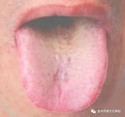 Tongue Diagnosis in Traditional Chinese Medicine: Tongue Coating