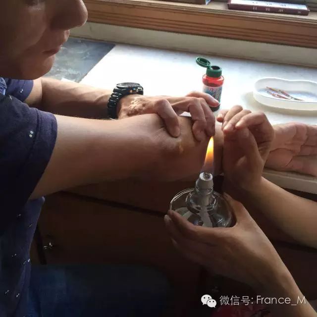 Fire Needle Therapy for Vitiligo