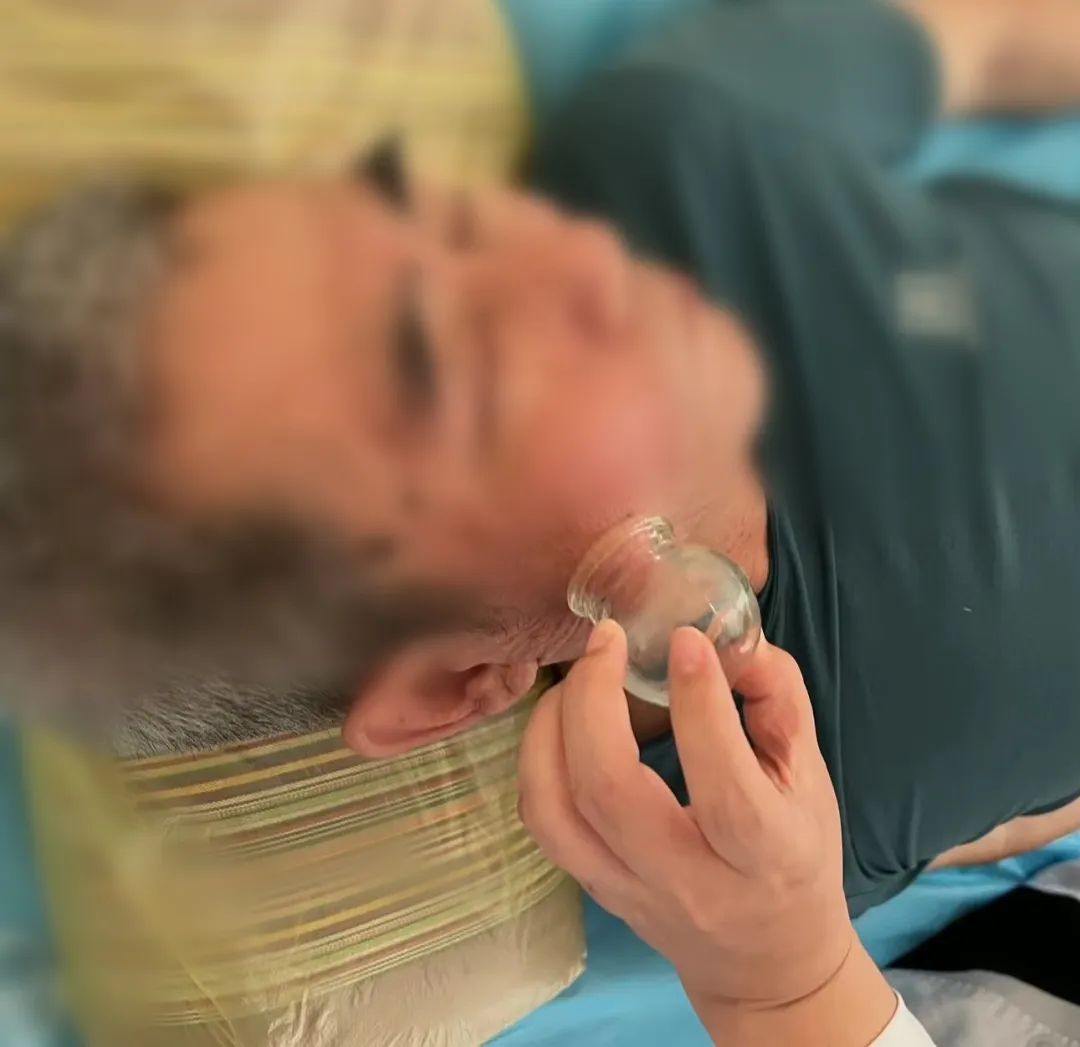 Cupping Therapy in Traditional Chinese Medicine: The Unique Method of Flash Cupping