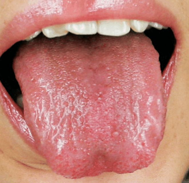 What Does the Tongue of a Person with Yin Deficiency Look Like?