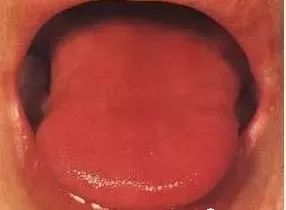Understanding Tongue Diagnosis in Traditional Chinese Medicine (with Tongue Diagnosis Illustrations)
