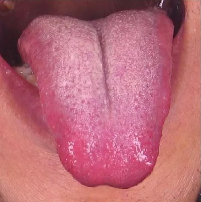 Understanding Health Through Tongue Diagnosis in Traditional Chinese Medicine