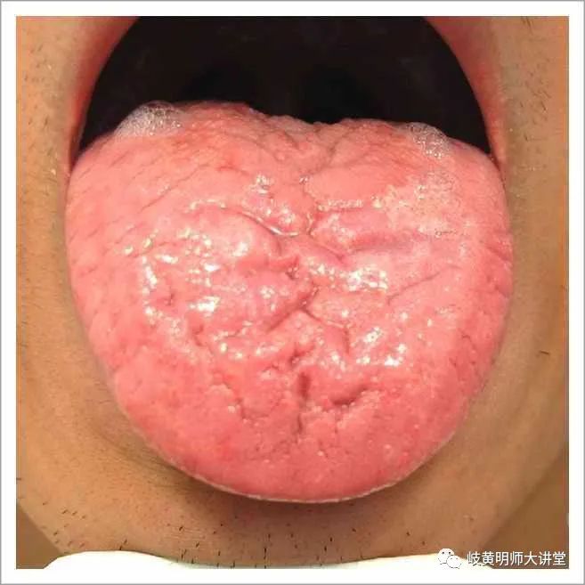 Traditional Chinese Medicine Tongue Diagnosis: Illustrated Guide to 14 Types of Tongue Shapes and Qualities