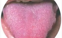 Observing Tongue Coating to Assess Health: A Summary of Classic Tongue Signs in Traditional Chinese Medicine