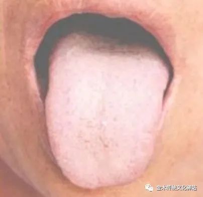 Tongue Diagnosis in Traditional Chinese Medicine: Characteristics of Tongue Coating