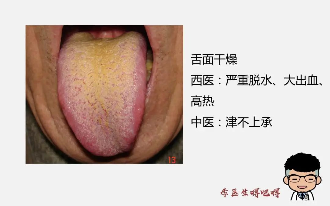 What Level of Tongue Diagnosis Does Western Medicine Have? Part 2: Tongue Quality and Coating