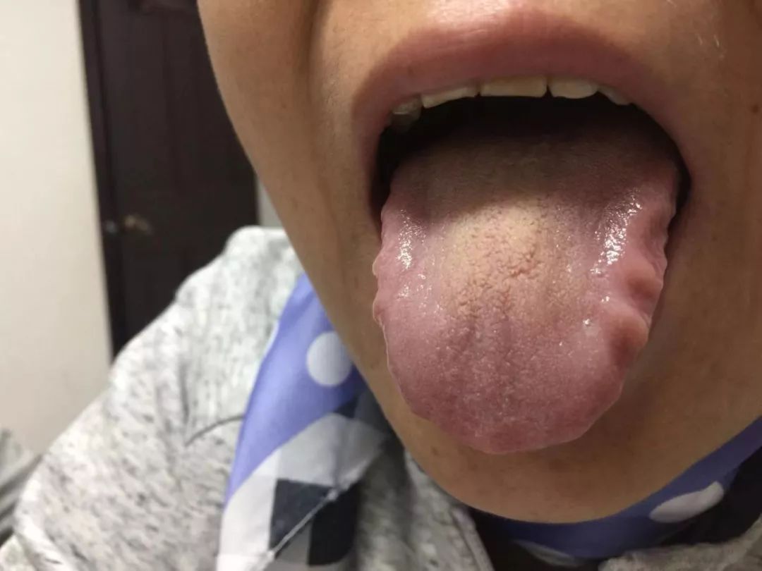 A Series on Tongue Diagnosis