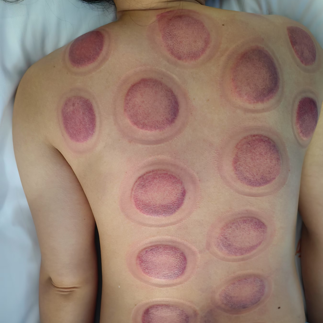 Balancing Cupping Therapy: Aiding Recovery for Cerebrovascular Disease Patients