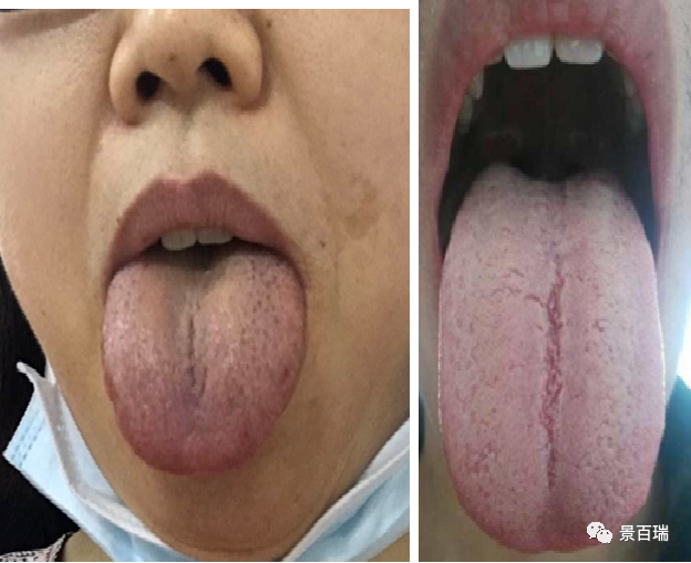 Basic Tongue Diagnosis - Tongue Body and Tongue Coating