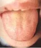 Comprehensive Guide to Tongue Diagnosis: Learn How Your Tongue Reflects Your Health!