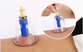 Promotion of Cupping Therapy in Traditional Chinese Medicine