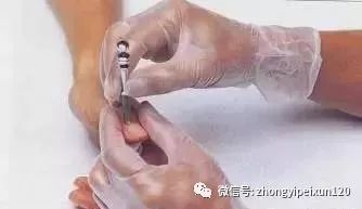 Bloodletting Therapy in Acupuncture: Fear No Illness! (Including Relevant Acupoint Treatments for Related Conditions)