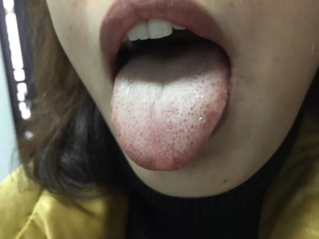 A Series on Tongue Diagnosis