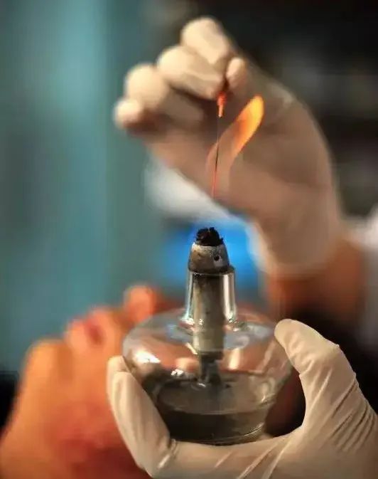 Understanding Needle Cleansing and Fire Needle Therapy in Acne Treatment