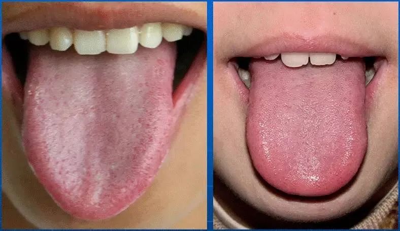Tongue Diagnosis - Illustrated Guide to Tongue Manifestations