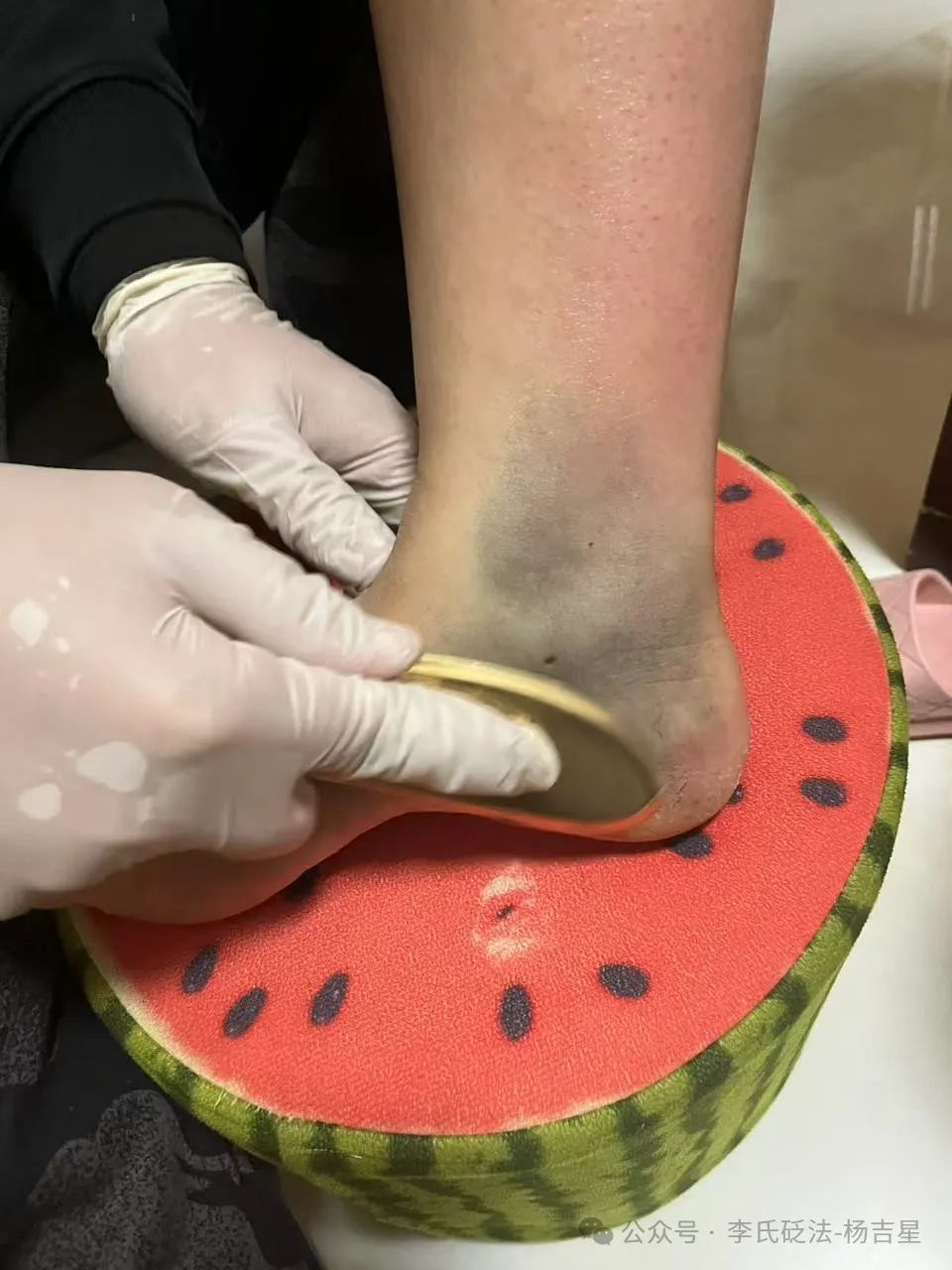 How to Use Gua Sha for Gout Management? Case Study (1)