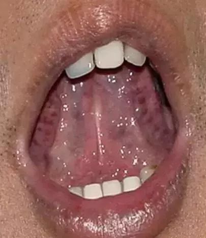 The Most Comprehensive Guide to Tongue Diagnosis! Master It and Become a Tongue Diagnosis Expert
