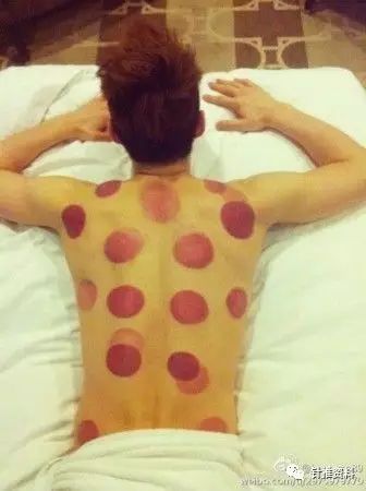The Techniques and Diagnosis of Cupping Therapy in Traditional Chinese Medicine
