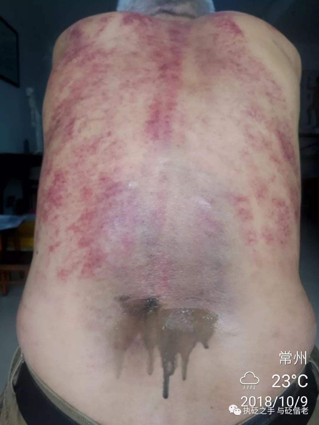 Black Sha: The Surprising Discovery of Copper Gua Sha
