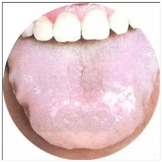 Observing Tongue Coating to Assess Health: A Summary of Classic Tongue Signs in Traditional Chinese Medicine