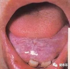 Understanding Tongue Diagnosis in Traditional Chinese Medicine (with Tongue Diagnosis Illustrations)