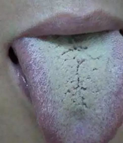 The Most Comprehensive Guide to Tongue Diagnosis! Master It and Become a Tongue Diagnosis Expert