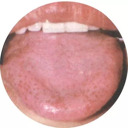 Comprehensive Guide to Tongue Diagnosis: A Must-Collect!
