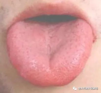 Tongue Diagnosis in Traditional Chinese Medicine: Characteristics of Tongue Coating