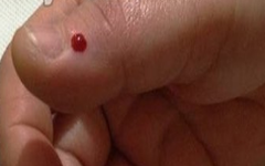 Acupuncture Department II: Unique Treatments in Traditional Chinese Medicine