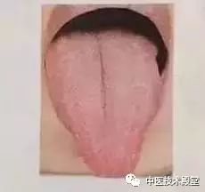 Tongue Diagnosis: Issues Revealed and Simple TCM Remedies