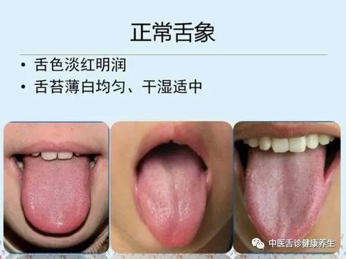 Nine Tongue Signs Indicating Qi Deficiency: Timely Adjustment and Medical Attention Recommended