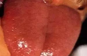 The Most Comprehensive Guide to Tongue Diagnosis! Master It and Become a Tongue Diagnosis Expert