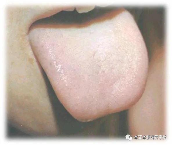 Tongue Diagnosis Series 3: Precise Differentiation of Tongue Coating, Quality, and Shape