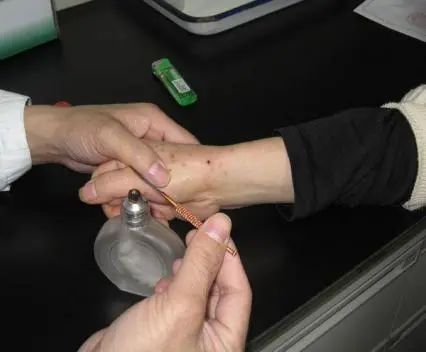 Acupuncture Department II: What Conditions Can Fire Needle Therapy Treat?