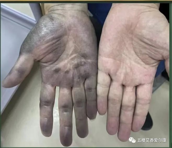 Summary of Common Diseases and Gua Sha Treatment Plans Including Human Reflex Maps, Contraindications, and Diagnosis of Sha Patterns