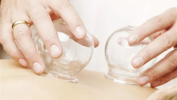 Cupping Therapy: A Traditional Chinese Medicine Approach to Health