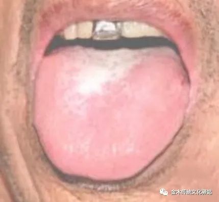 Tongue Diagnosis in Traditional Chinese Medicine: Characteristics of Tongue Coating