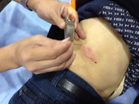 Acupuncture Department II: What Conditions Can Fire Needle Therapy Treat?