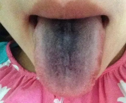 Tongue Coating Diagnosis in Traditional Chinese Medicine
