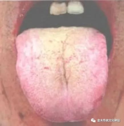 Tongue Diagnosis in Traditional Chinese Medicine: Tongue Coating