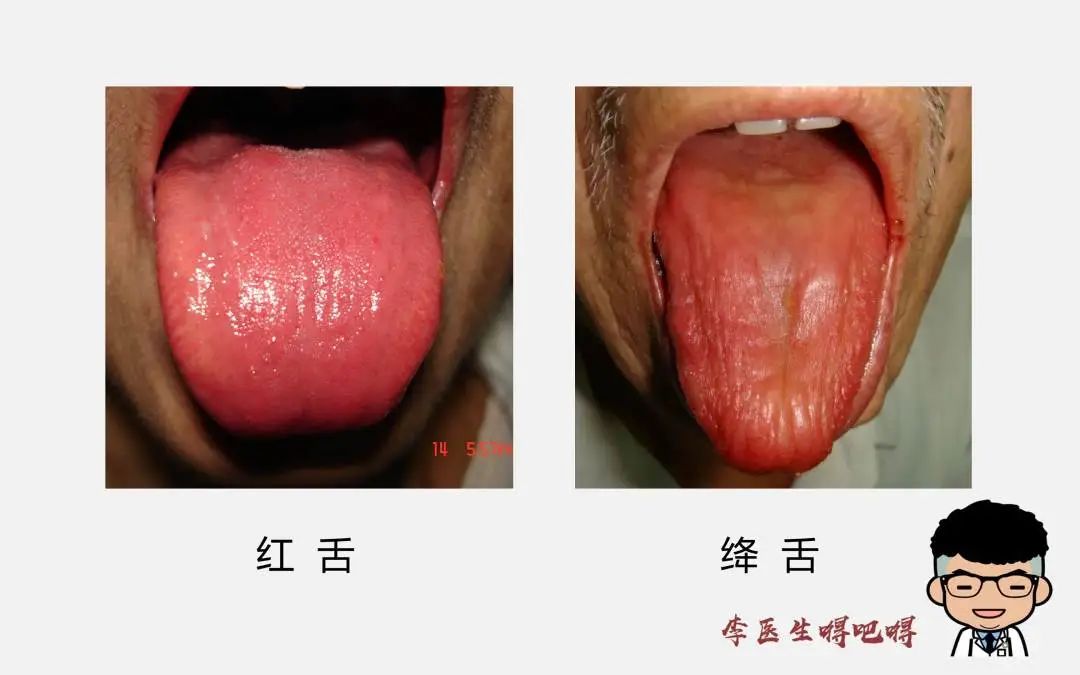 What Level of Tongue Diagnosis Does Western Medicine Have? Part 2: Tongue Quality and Coating